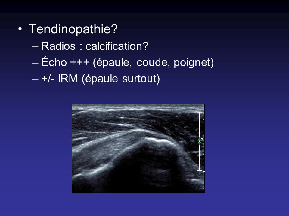 Tendinopathie Radios : calcification