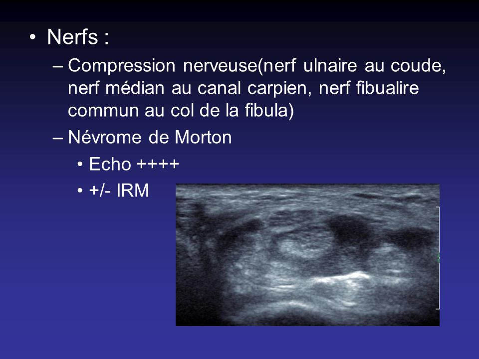 Nerfs : Compression nerveuse(nerf ulnaire au coude, nerf médian au canal carpien, nerf fibualire commun au col de la fibula)