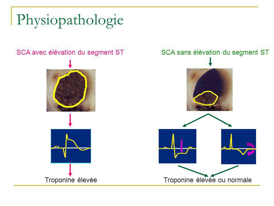 Physiopathologie SCA avec élévation du segment ST