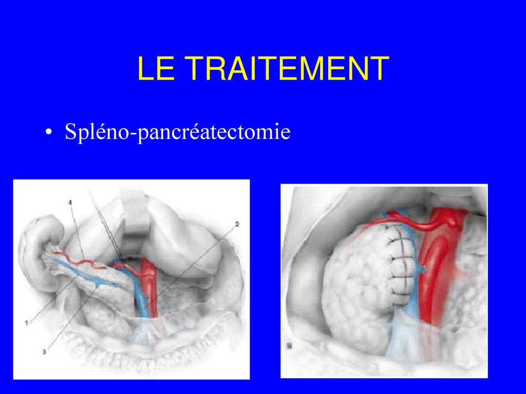 Les Tumeurs Du Pancréas - Ppt Télécharger