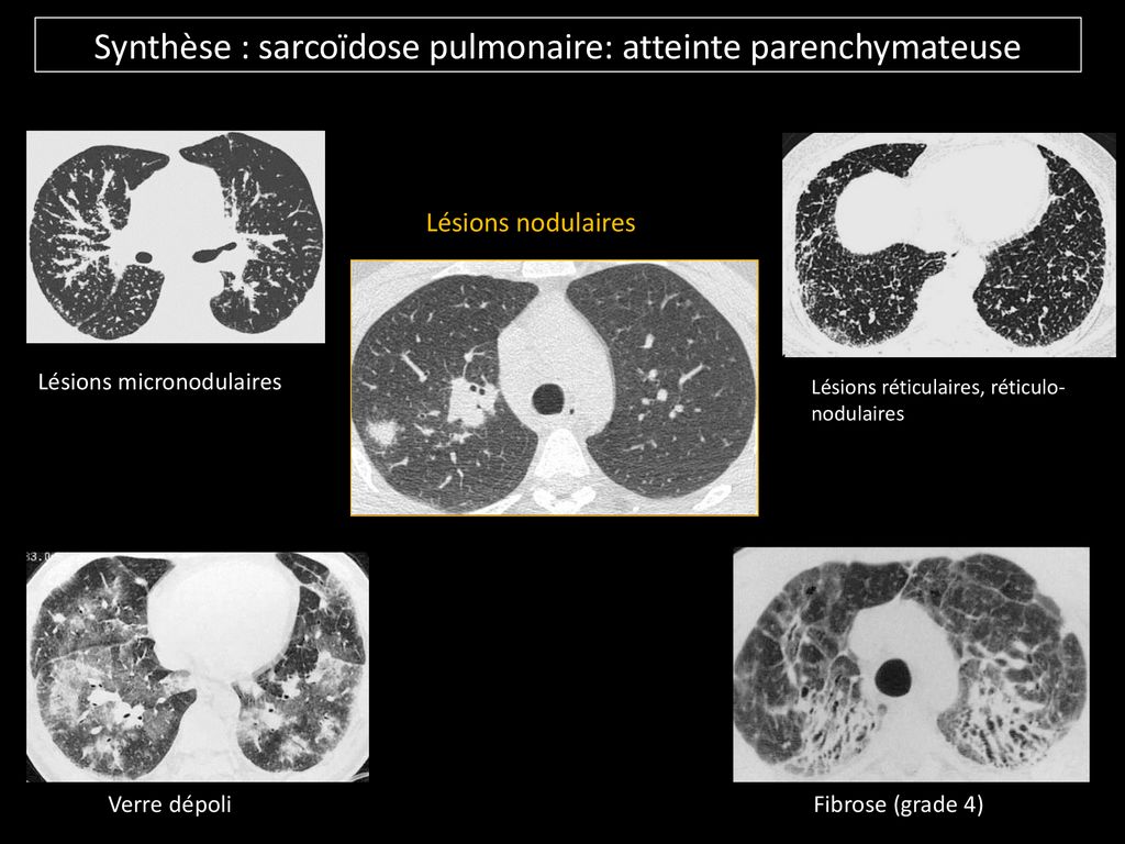 Sarcoïdose (Besnier-Boeck-Schaumann) - Ppt Télécharger