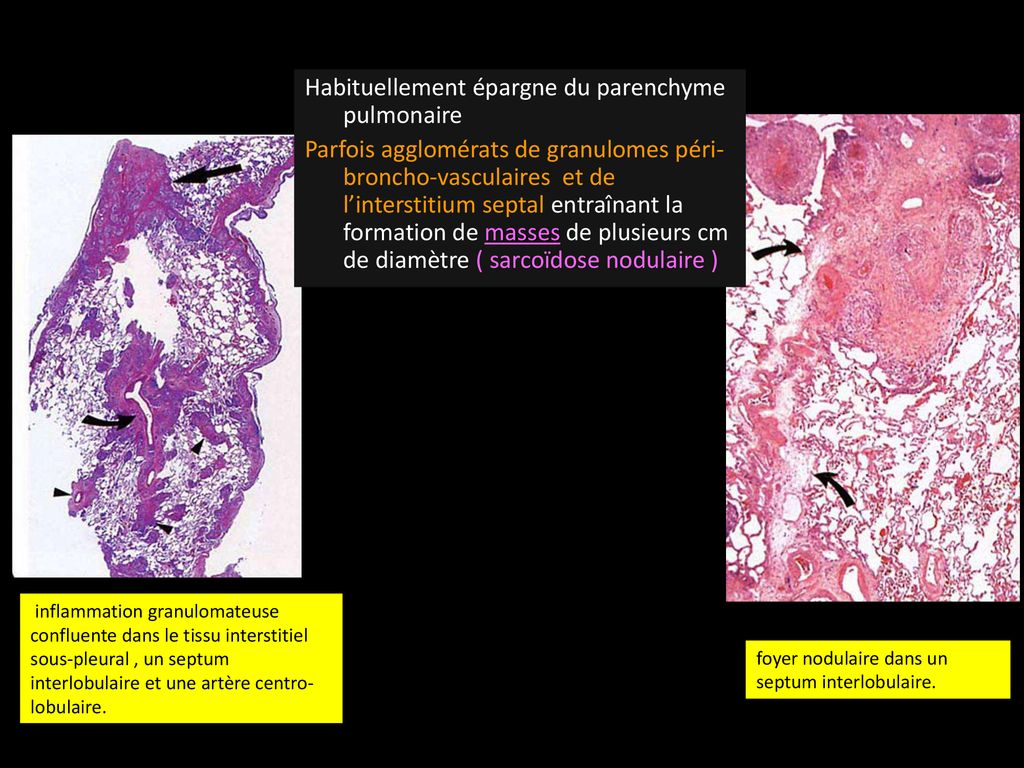 Sarcoïdose (Besnier-Boeck-Schaumann) - Ppt Télécharger