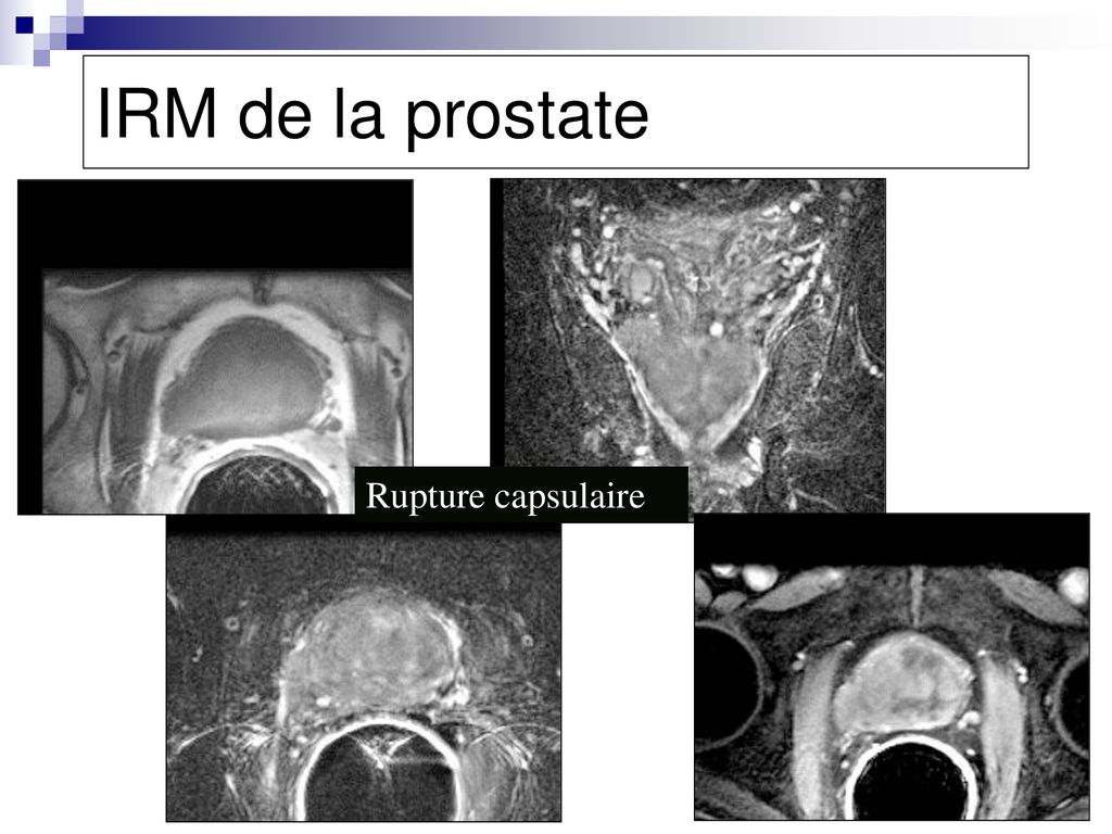 Irm Cancer De La Prostate Aspect Prostatite En Irm