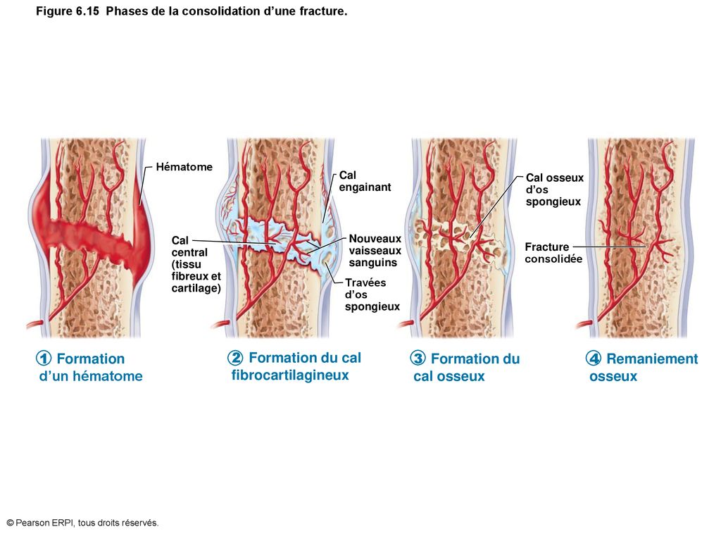 Figure 6.15 Phases de la consolidation d’une fracture.