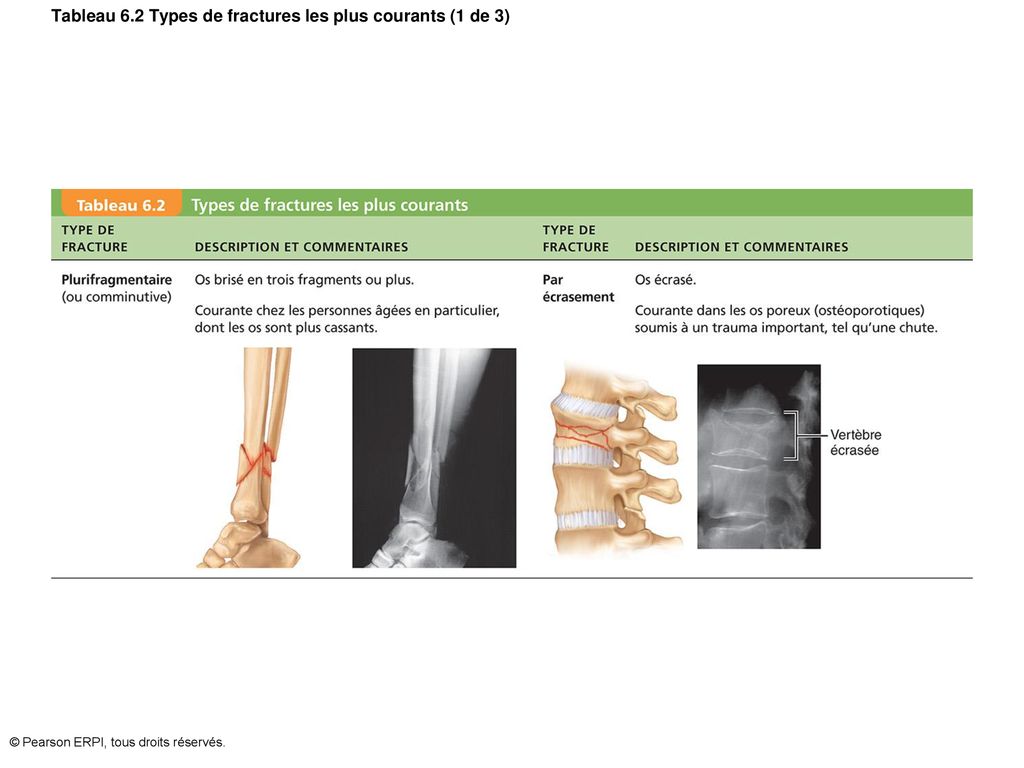 Tableau 6.2 Types de fractures les plus courants (1 de 3)
