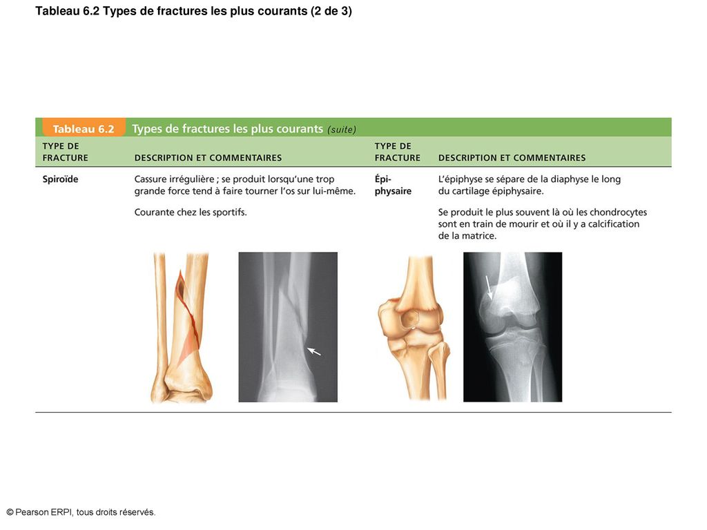 Tableau 6.2 Types de fractures les plus courants (2 de 3)