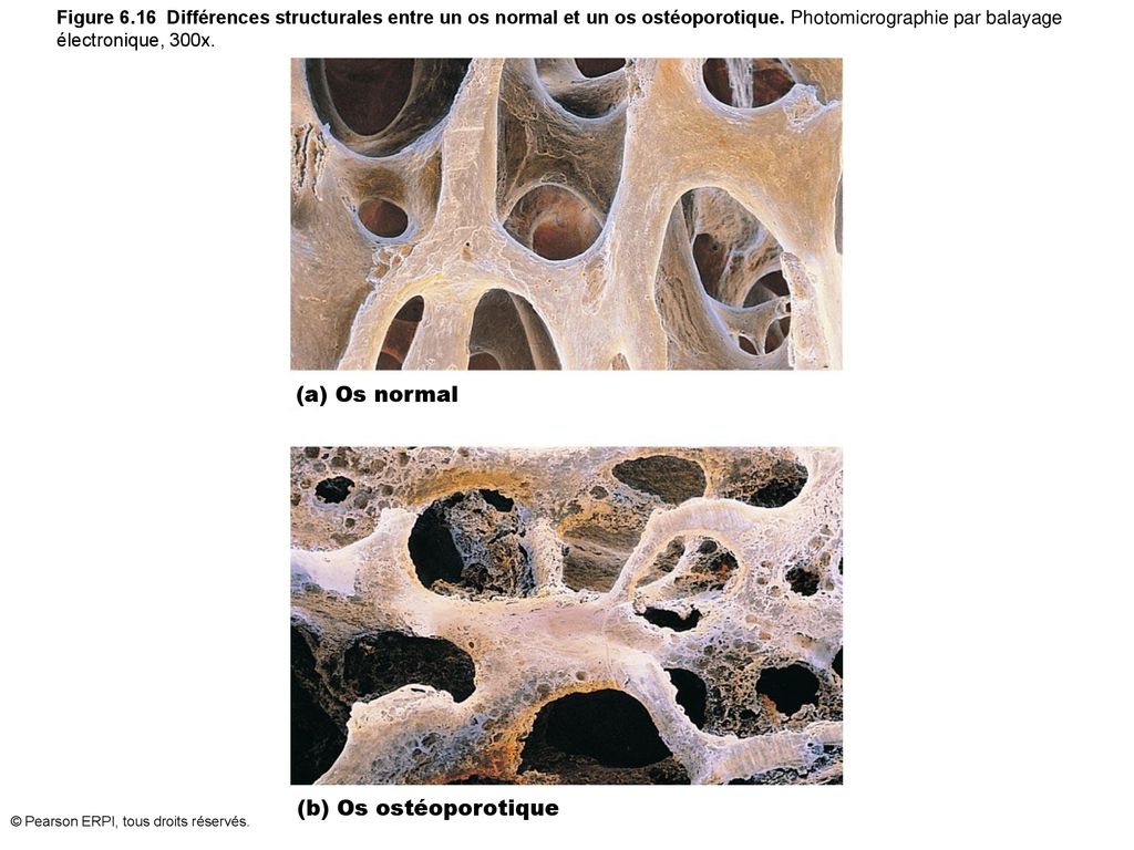(a) Os normal (b) Os ostéoporotique