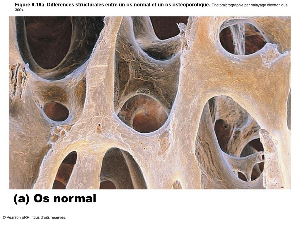 Figure 6.16a Différences structurales entre un os normal et un os ostéoporotique. Photomicrographie par balayage électronique, 300x.