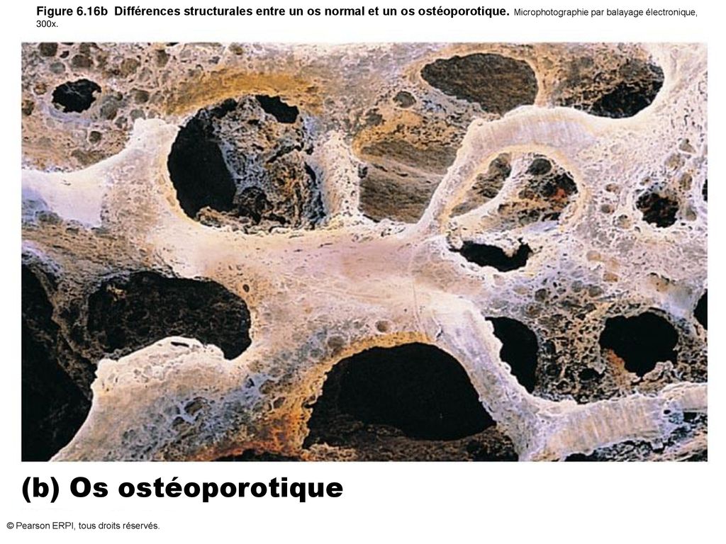 Figure 6.16b Différences structurales entre un os normal et un os ostéoporotique. Microphotographie par balayage électronique, 300x.