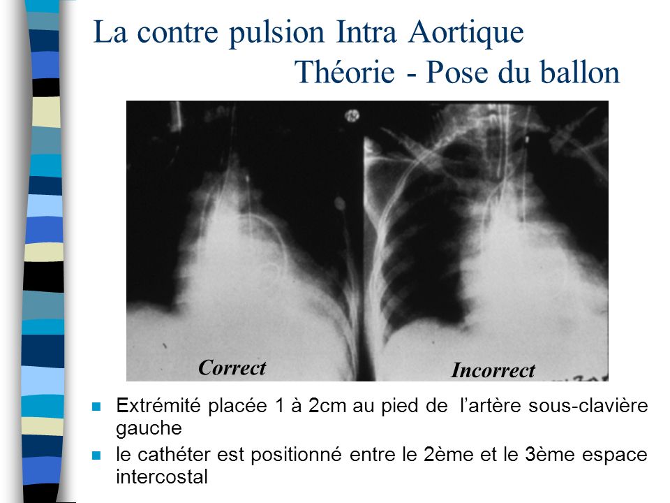 La contre pulsion Intra Aortique Théorie - Pose du ballon