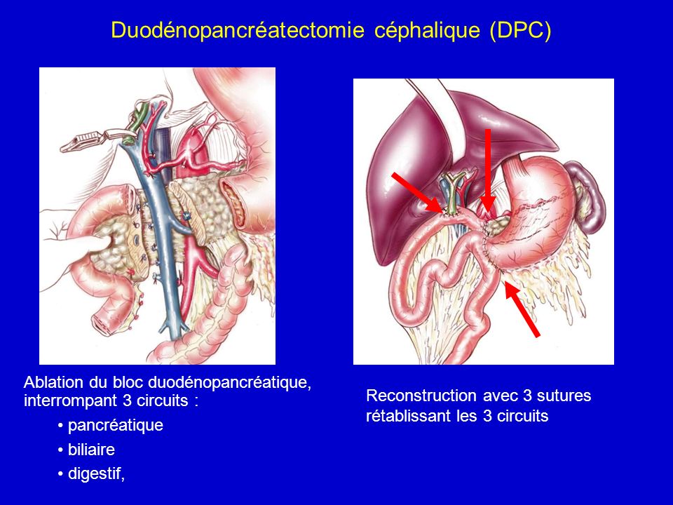 Duodénopancréatectomie céphalique (DPC)
