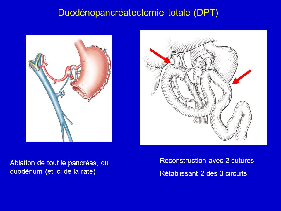 Duodénopancréatectomie totale (DPT)
