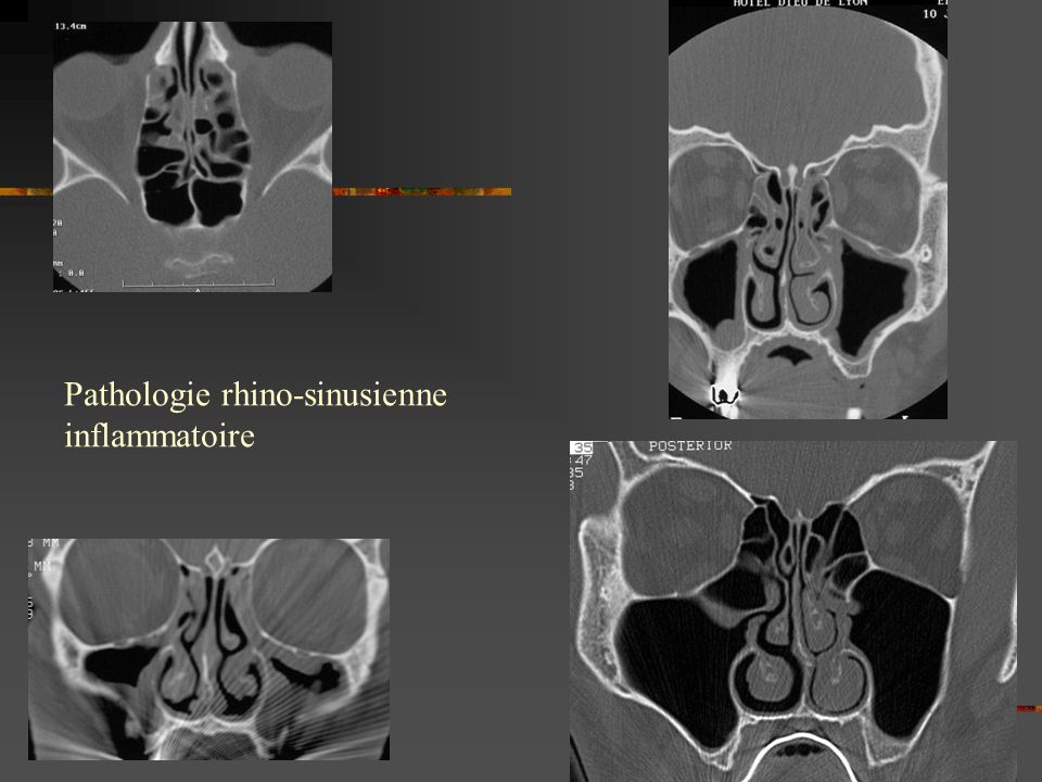 Pathologie rhino-sinusienne