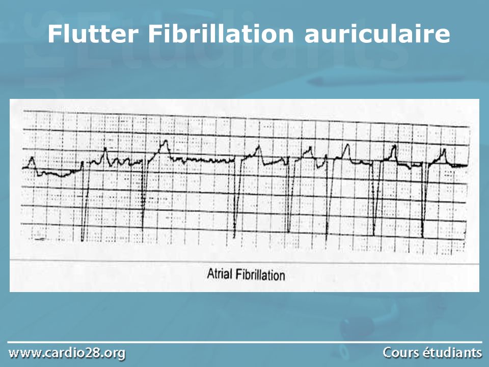 Flutter Fibrillation auriculaire