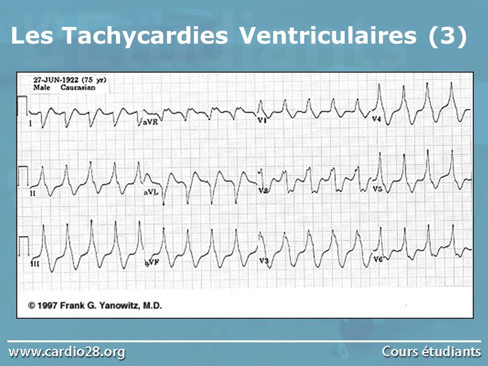 Les Tachycardies Ventriculaires (3)