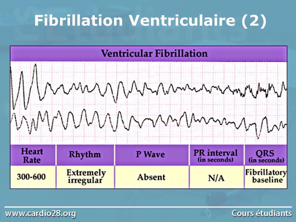 Fibrillation Ventriculaire (2)