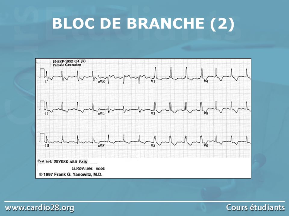 BLOC DE BRANCHE (2)