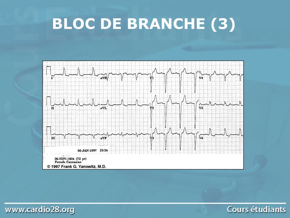 BLOC DE BRANCHE (3)