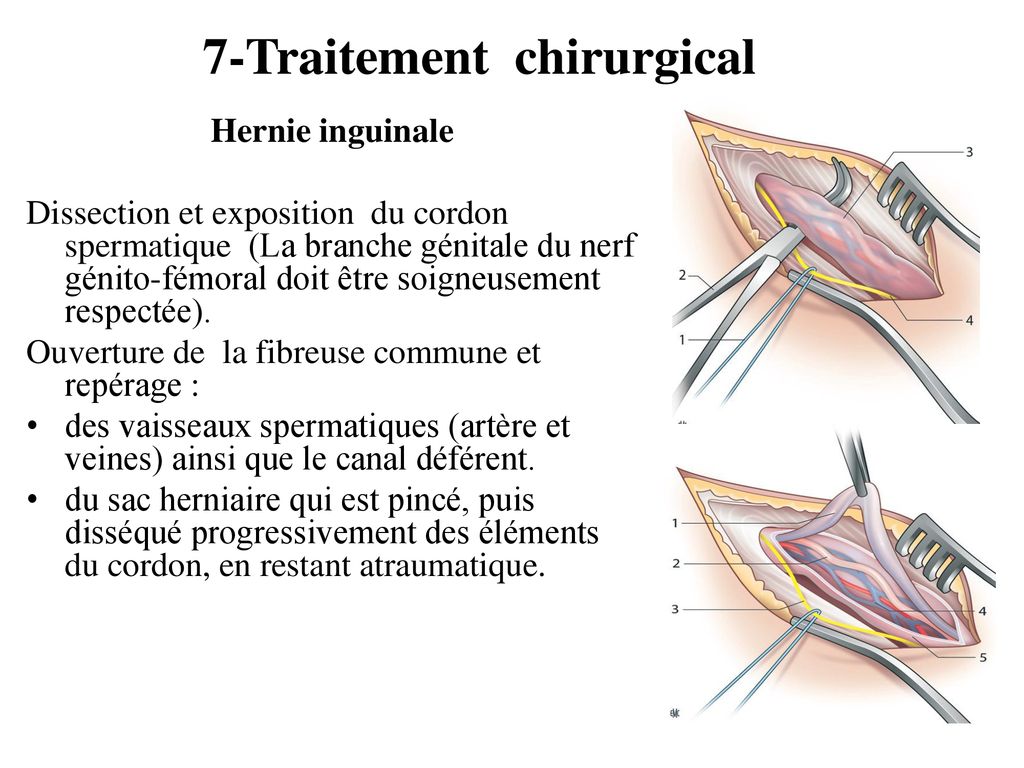 cordon spermatique du nerf ilio inguinal