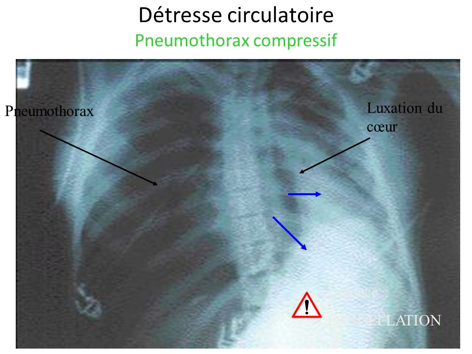 Détresse circulatoire Pneumothorax compressif