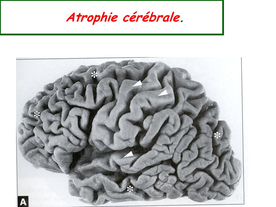 Atrophie cérébrale.