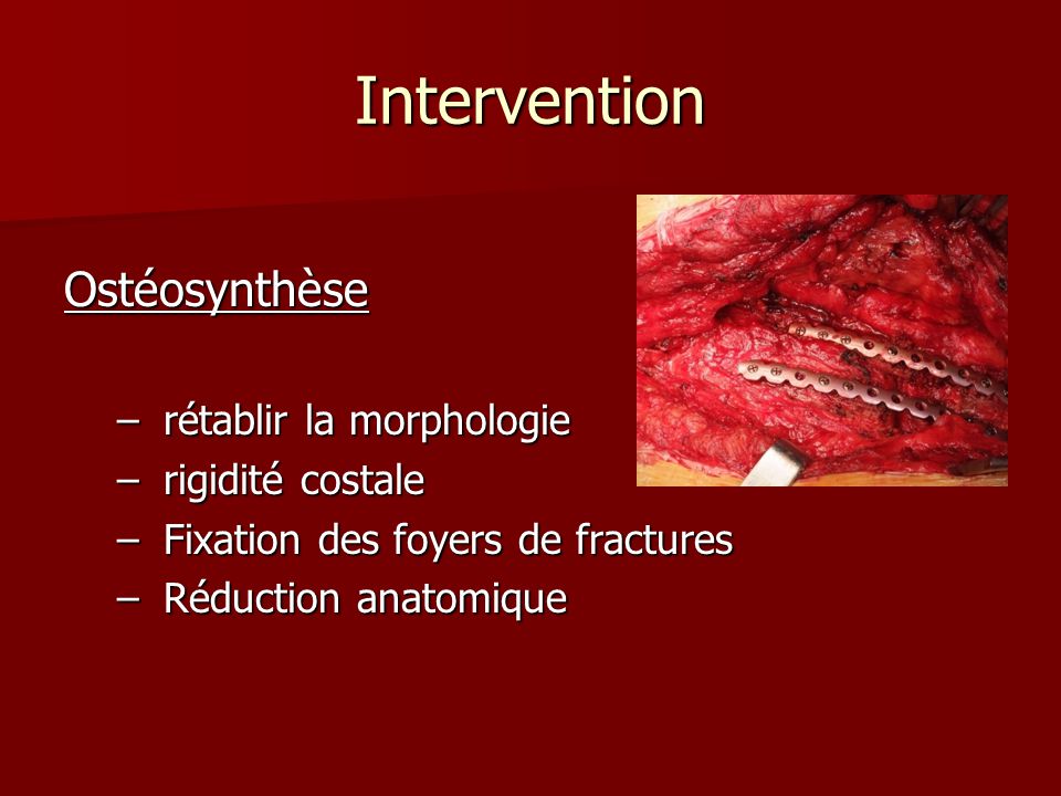OSTEOSYNTHESE COSTALE DANS LES TRAUMATISMES THORACIQUES - ppt ...