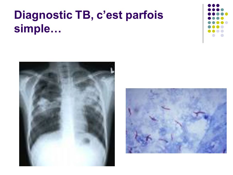 Diagnostic TB, c’est parfois simple…