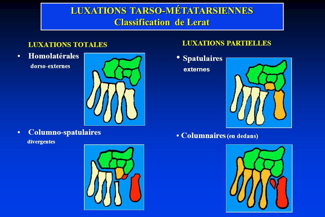 LUXATIONS TARSO-MÉTATARSIENNES Classification de Lerat