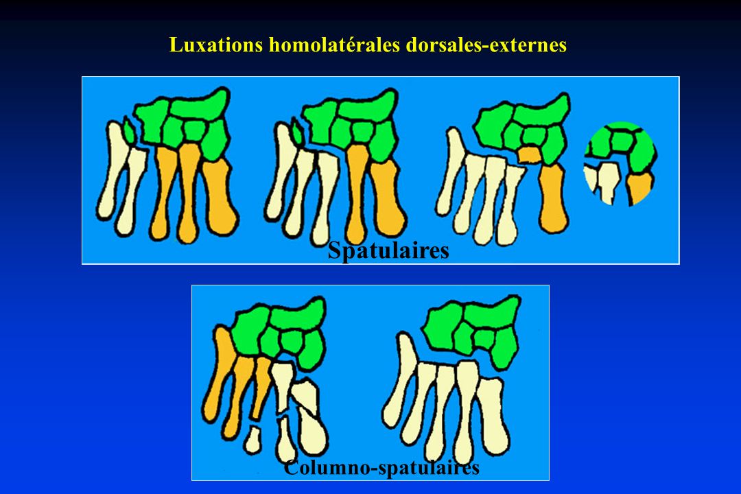 Luxations homolatérales dorsales-externes
