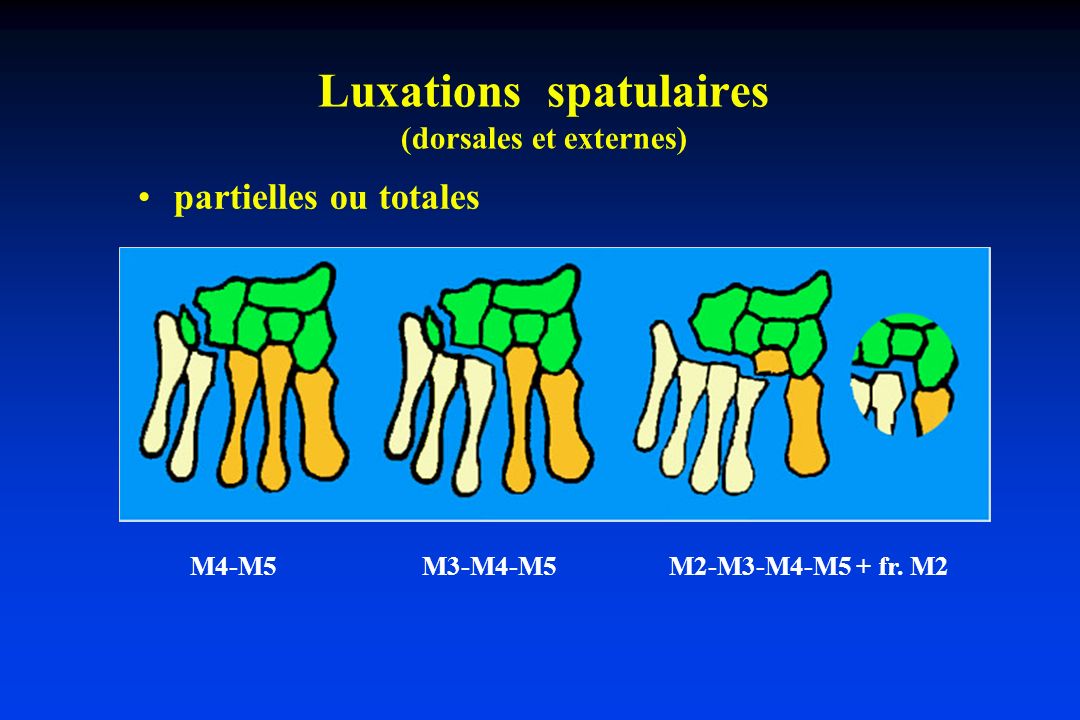 Luxations spatulaires (dorsales et externes)