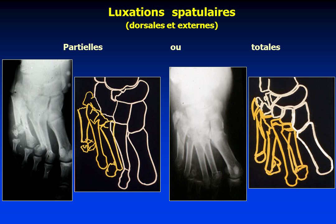Luxations spatulaires (dorsales et externes)