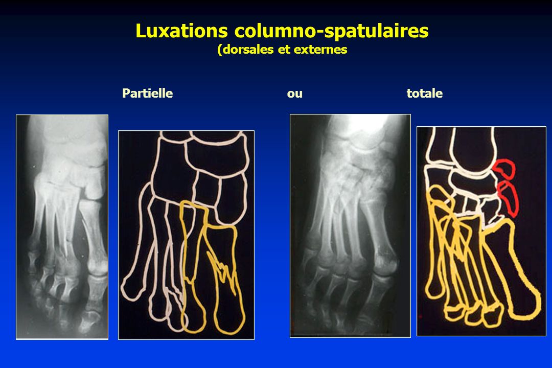 Luxations columno-spatulaires (dorsales et externes