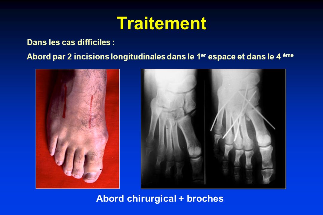 Abord chirurgical + broches