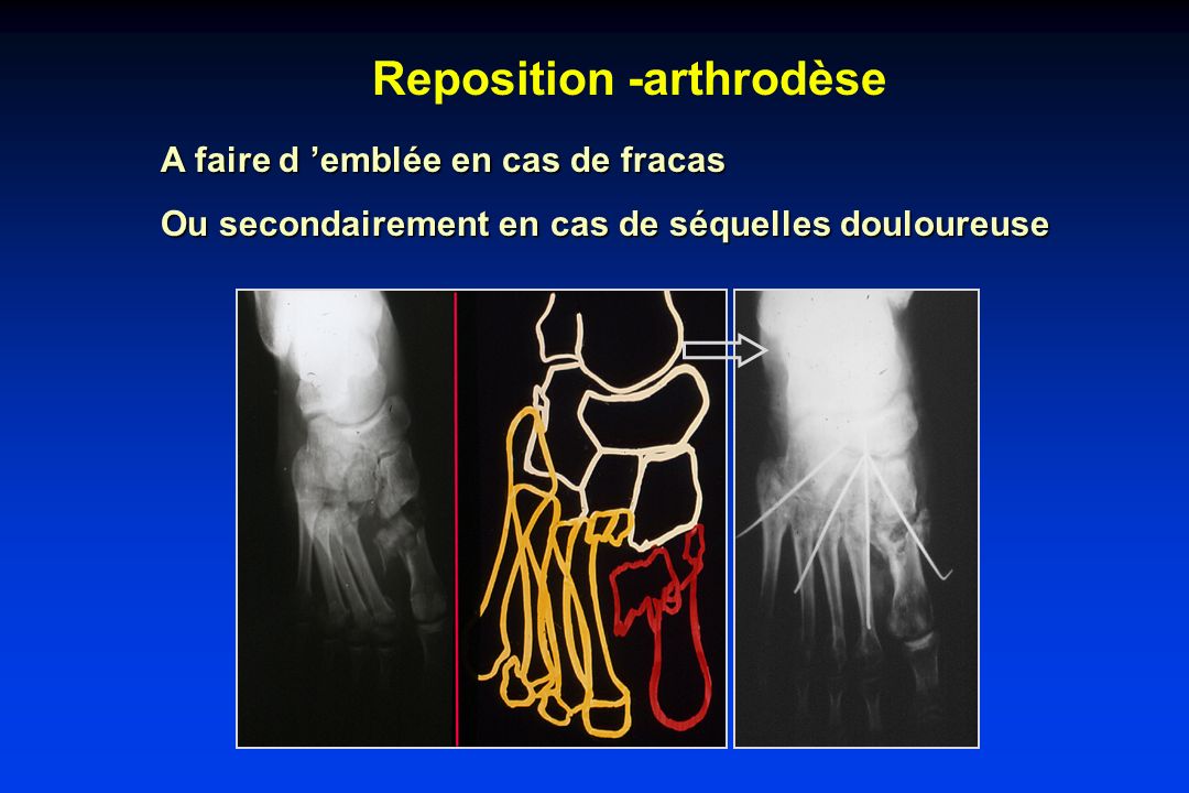 Reposition -arthrodèse