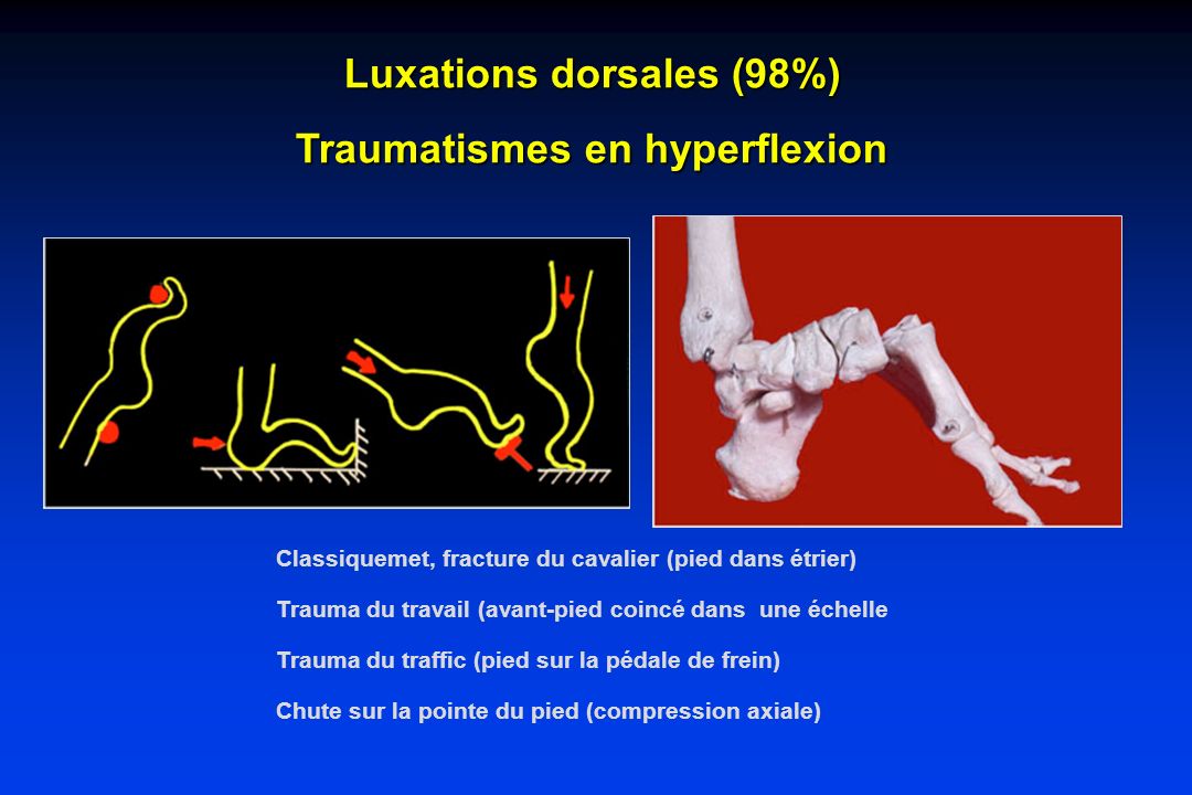 Luxations dorsales (98%) Traumatismes en hyperflexion