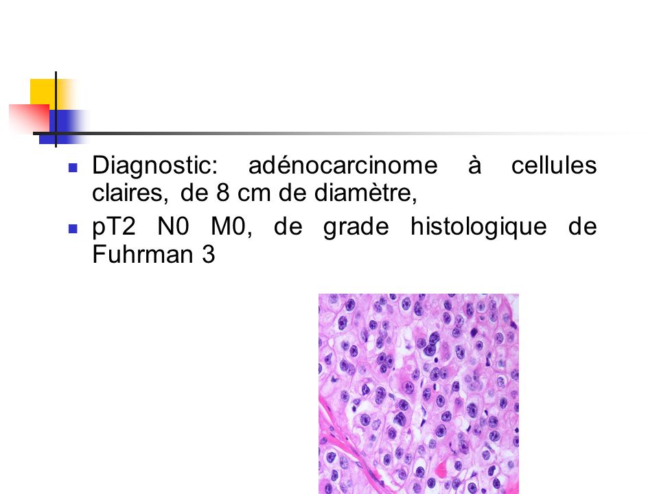 Diagnostic: adénocarcinome à cellules claires, de 8 cm de diamètre,