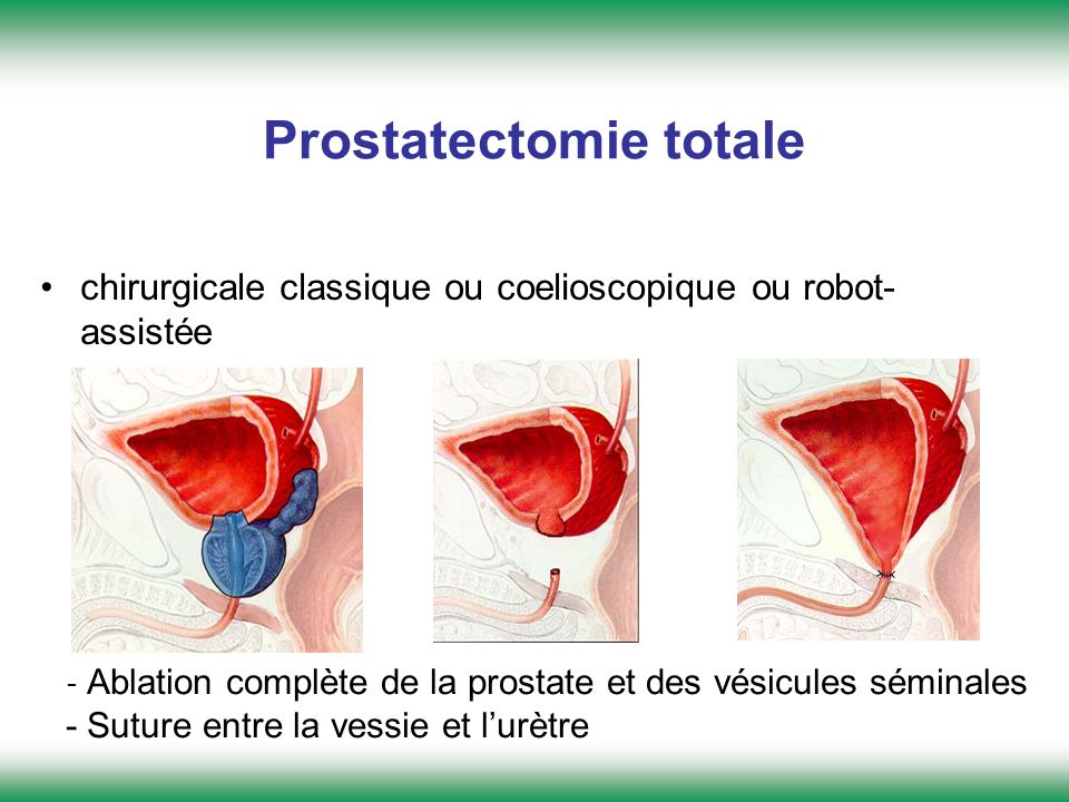 Prostatectomie totale