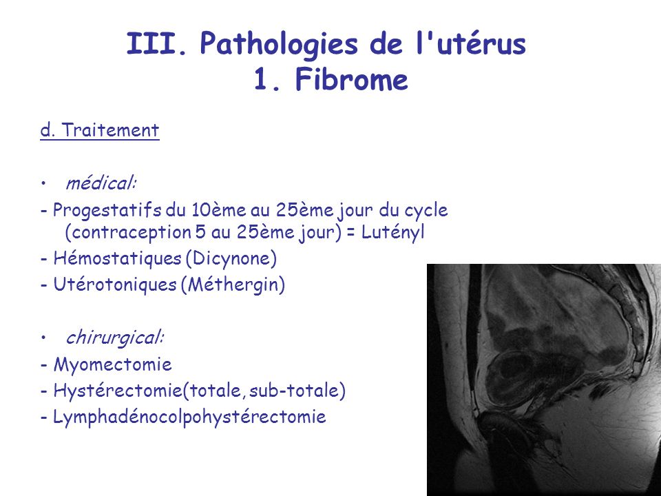 III. Pathologies de l utérus 1. Fibrome