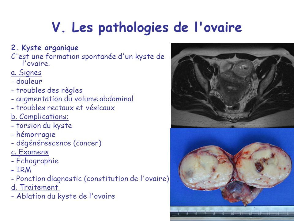 V. Les pathologies de l ovaire