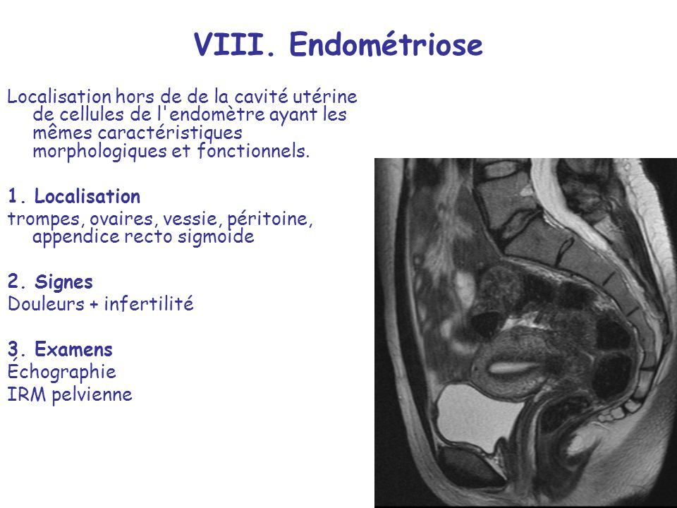 VIII. Endométriose