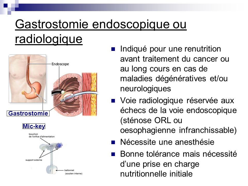 Gastrostomie endoscopique ou radiologique