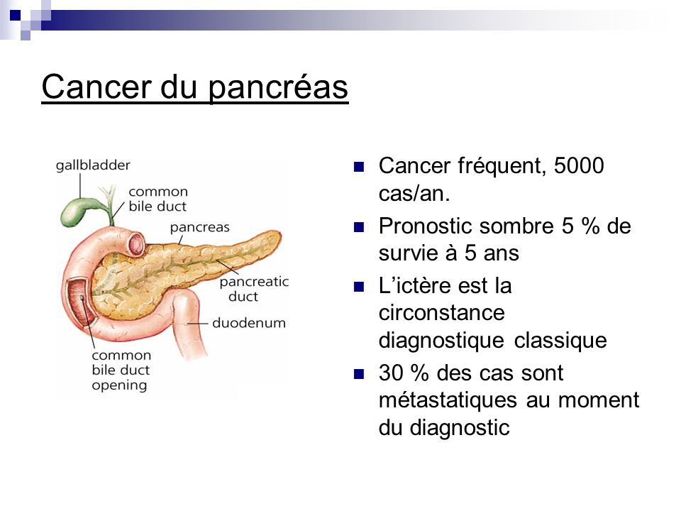 Cancer du pancréas Cancer fréquent, 5000 cas/an.