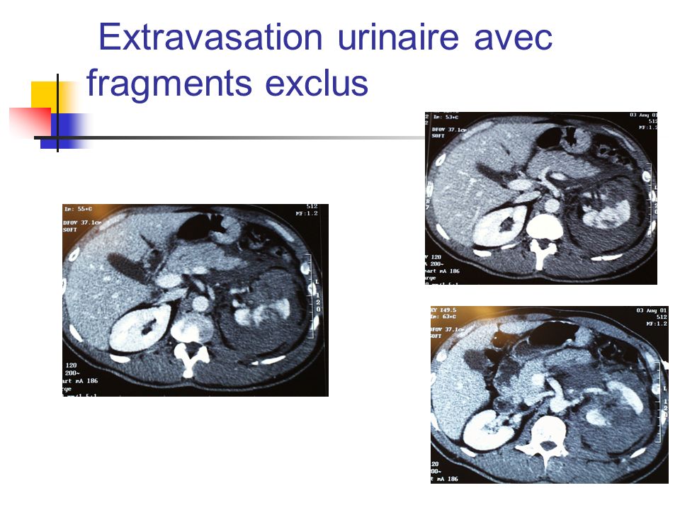 Extravasation urinaire avec fragments exclus