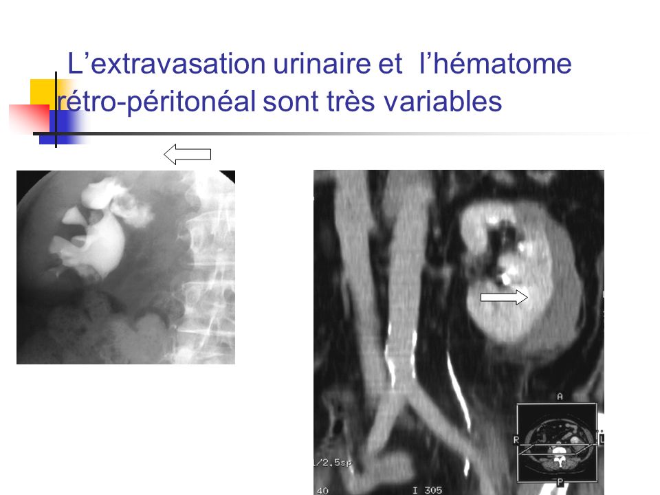 L’extravasation urinaire et l’hématome rétro-péritonéal sont très variables