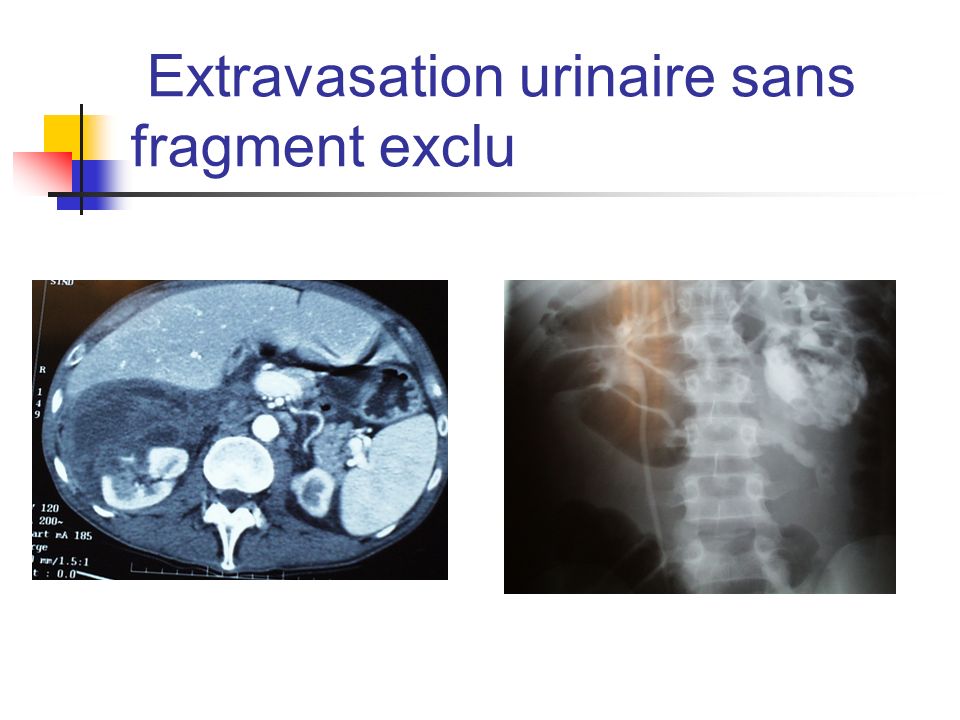 Extravasation urinaire sans fragment exclu
