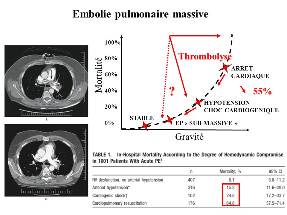 Embolie pulmonaire massive Thrombolyse Mortalité 55% Gravité 100%