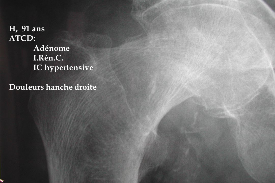 H, 91 ans ATCD: Adénome I.Rén.C. IC hypertensive Douleurs hanche droite