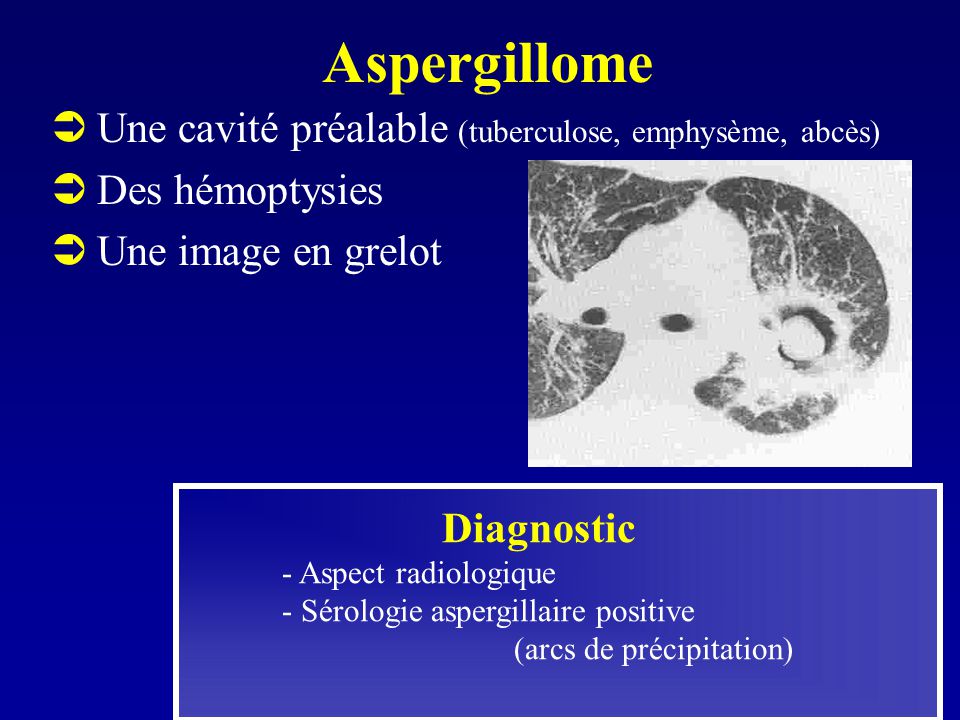 L Aspergillus En Pneumologie Ppt Video Online Telecharger