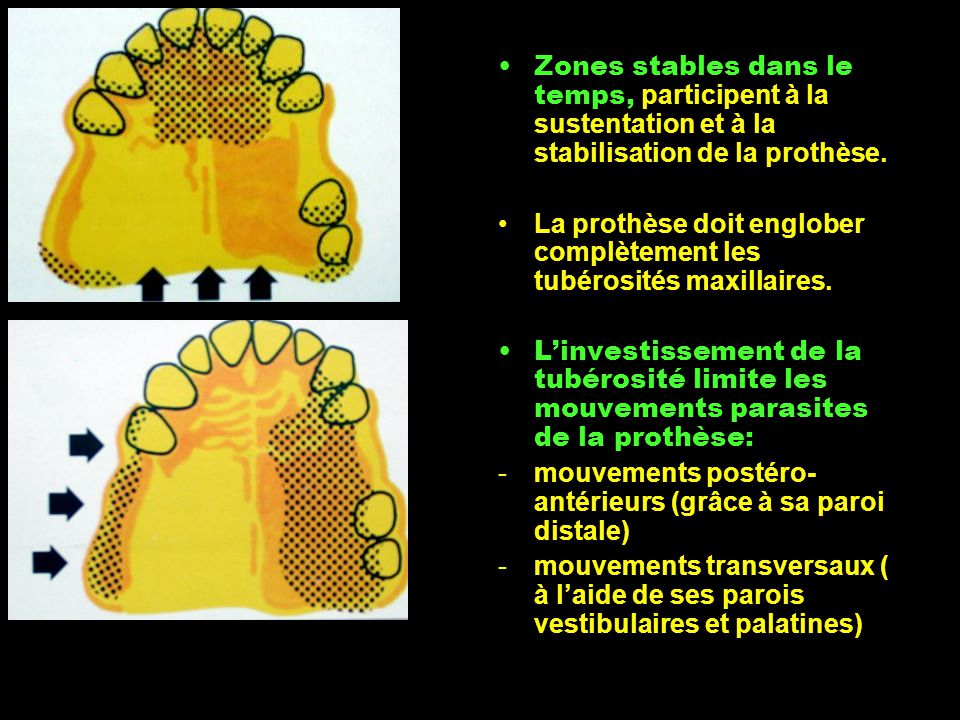 Zones stables dans le temps, participent à la sustentation et à la stabilisation de la prothèse.