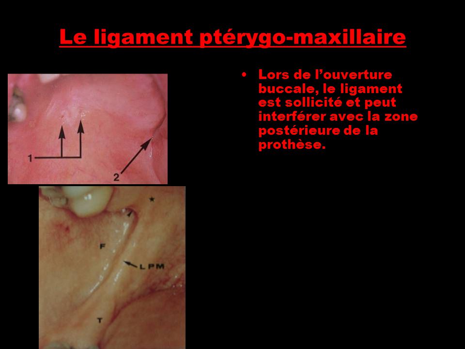 Le ligament ptérygo-maxillaire